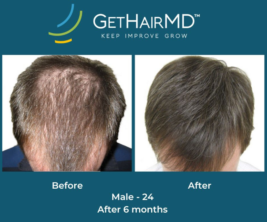 Hair restoration result 2