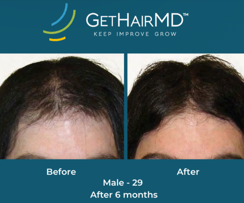 Hair restoration result 1