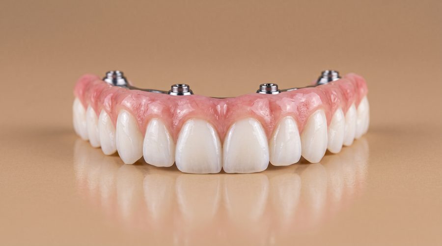 Prótesis dental fija sobre implantes con dientes blancos