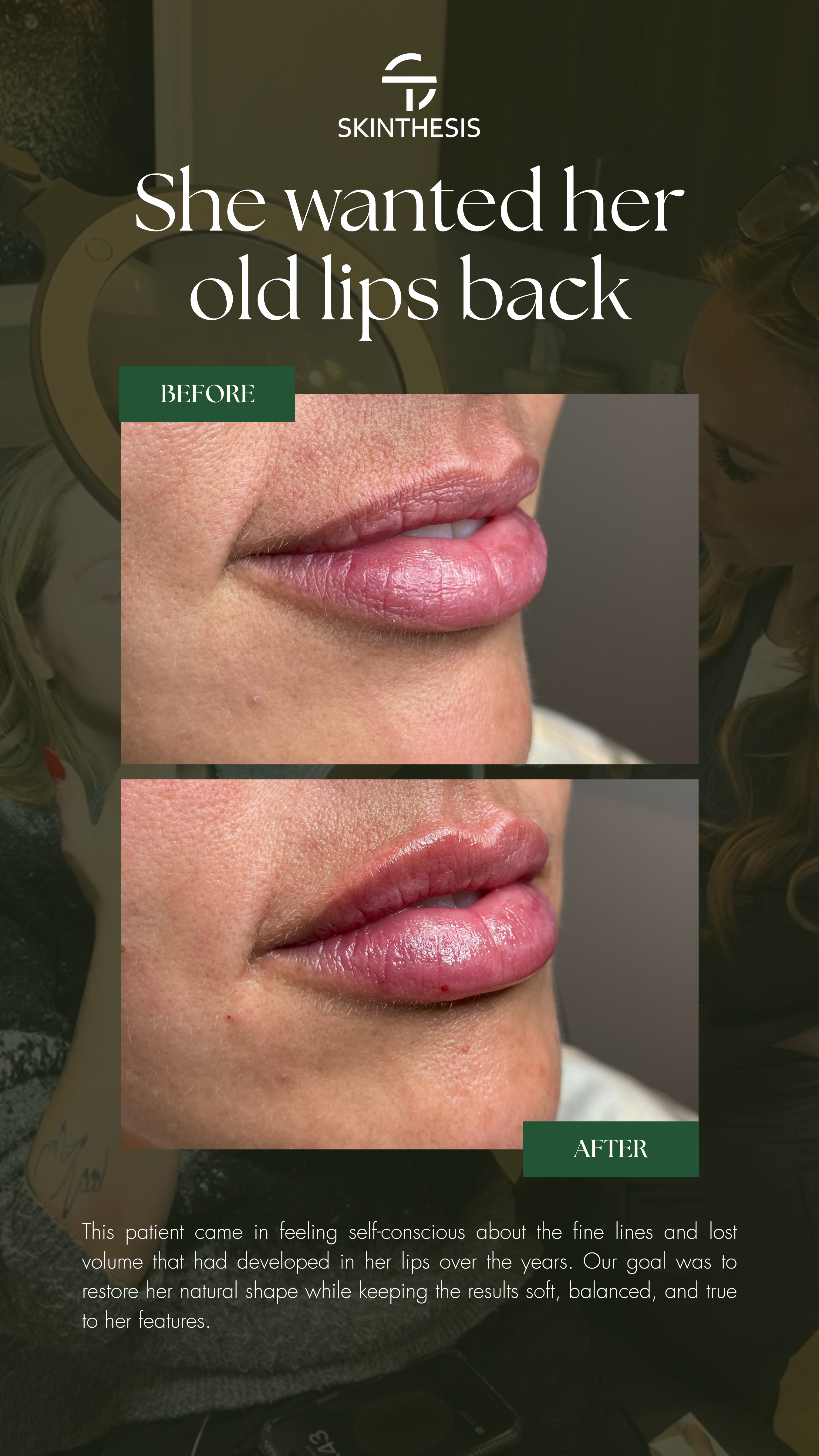 Before and After Lip Filler Case Study — Skinthesis