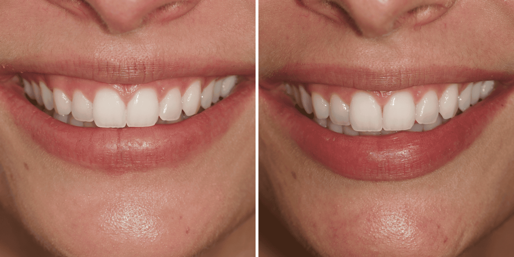 Antes y después de blanqueamiento dental, caso 1, en Grandas Dental Spa