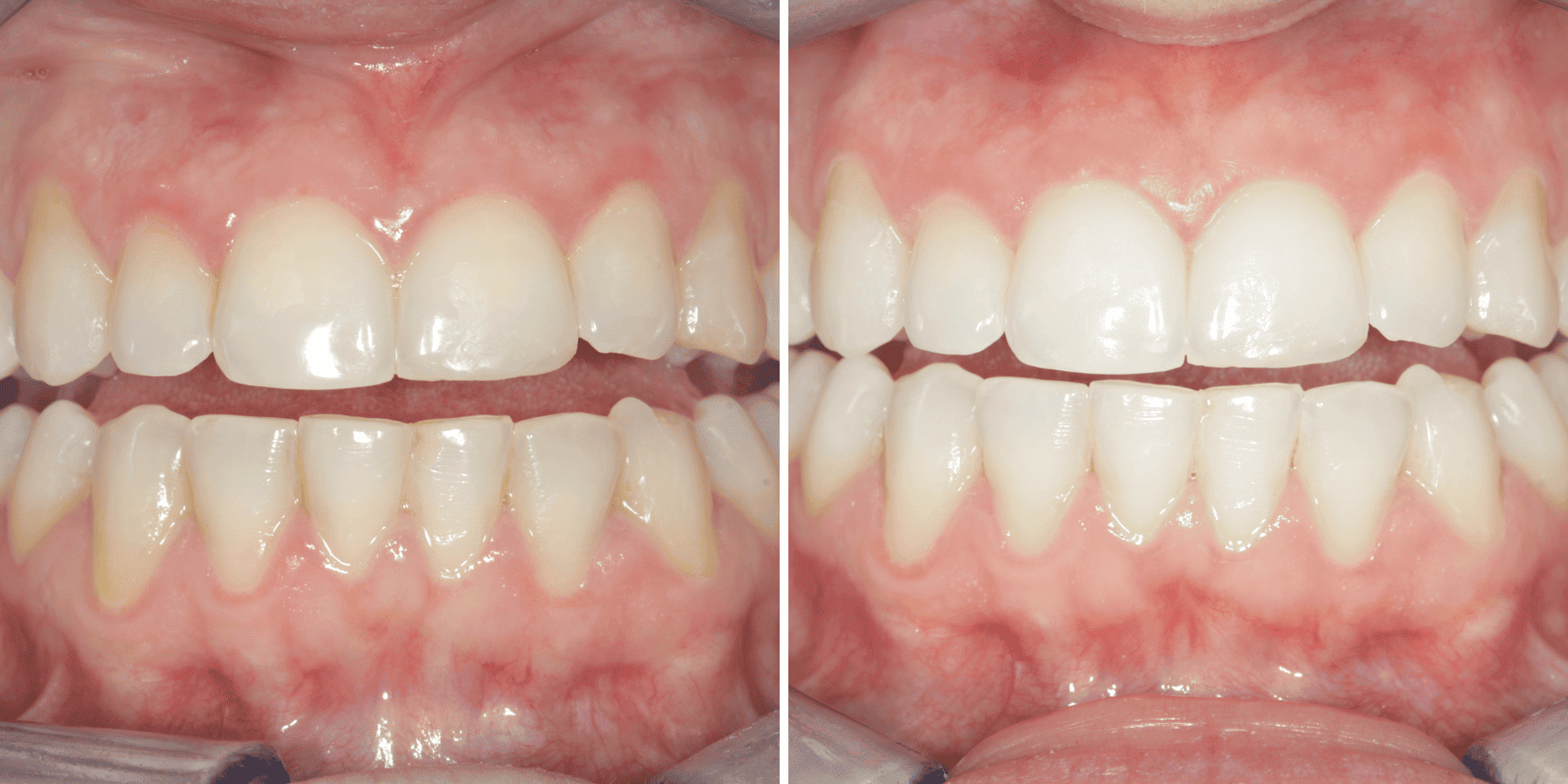 Antes y después de blanqueamiento dental, caso 3, en Grandas Dental Spa