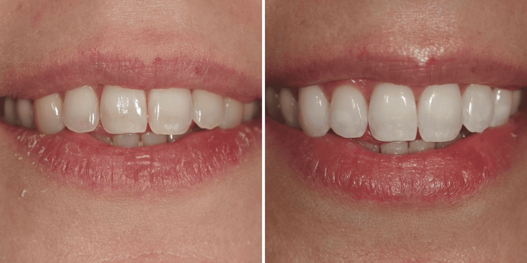 Antes y después de blanqueamiento dental, caso 4, en Grandas Dental Spa