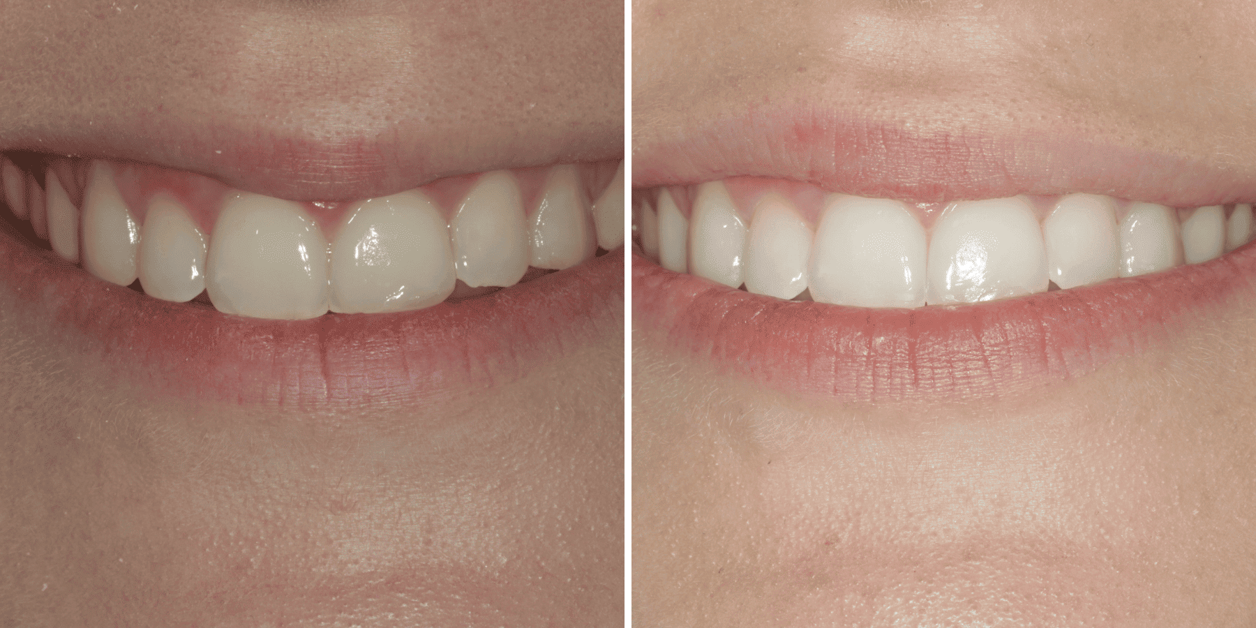 Antes y después de blanqueamiento dental, caso 2, en Grandas Dental Spa