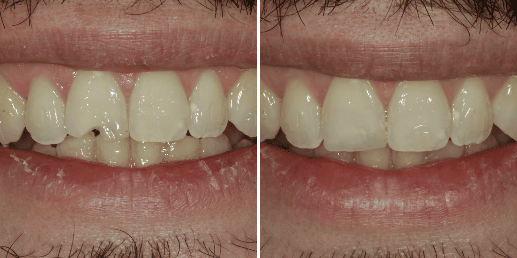 Antes y después de carillas, caso 1, en Grandas Dental Spa