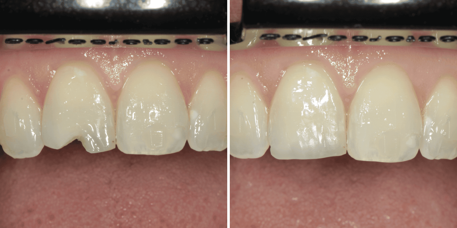 Antes y después de carillas, caso 3, en Grandas Dental Spa