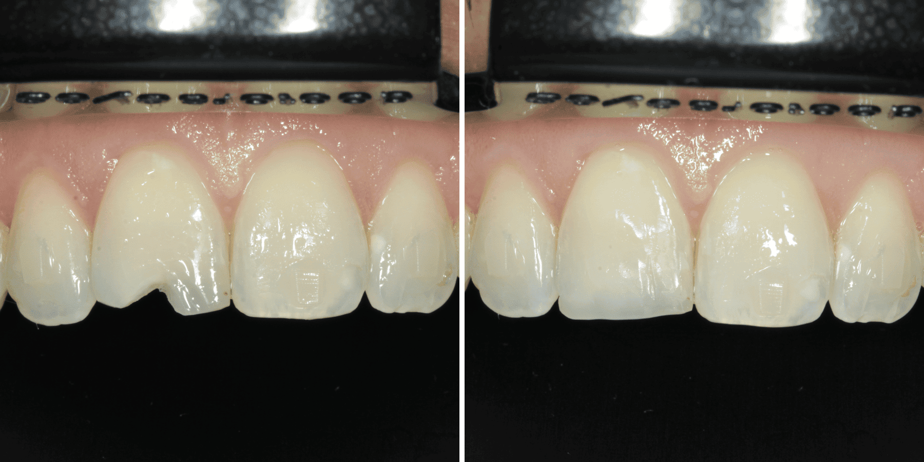 Antes y después de carillas, caso 2, en Grandas Dental Spa