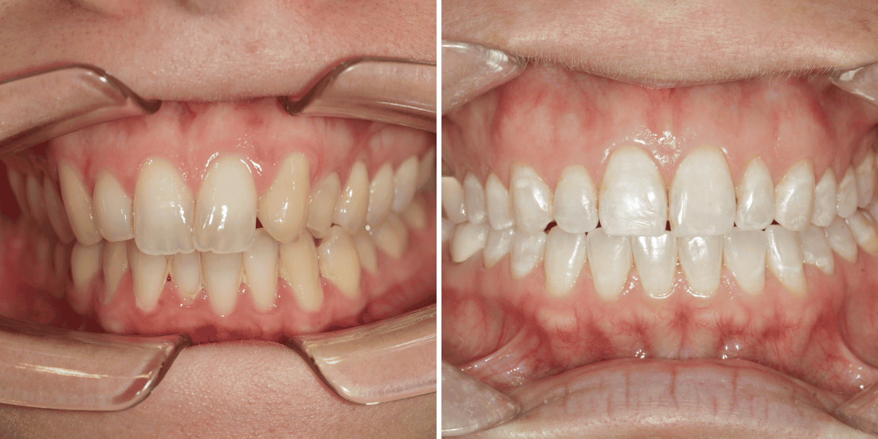 Antes y después de ortodoncia invisible y blanqueamiento, caso 4, en Grandas Dental Spa