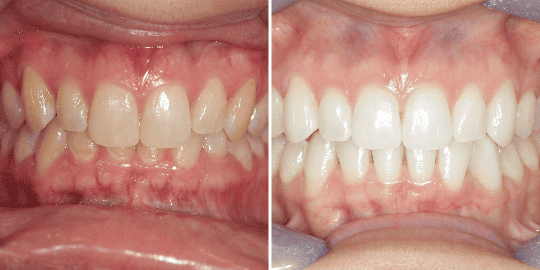 Antes y después de ortodoncia invisible y blanqueamiento, caso 1, en Grandas Dental Spa