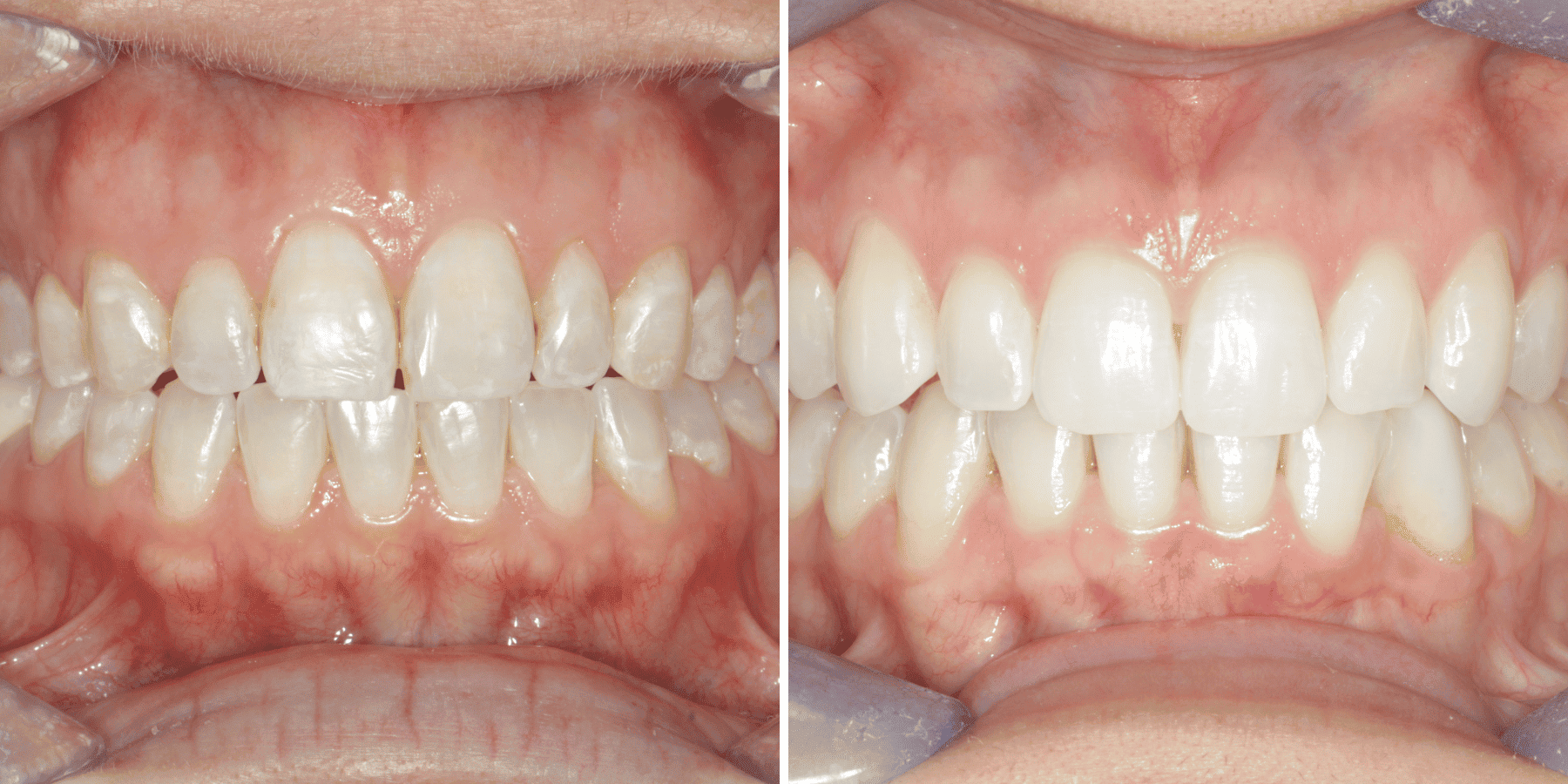Antes y después de ortodoncia invisible y blanqueamiento, caso 3, en Grandas Dental Spa