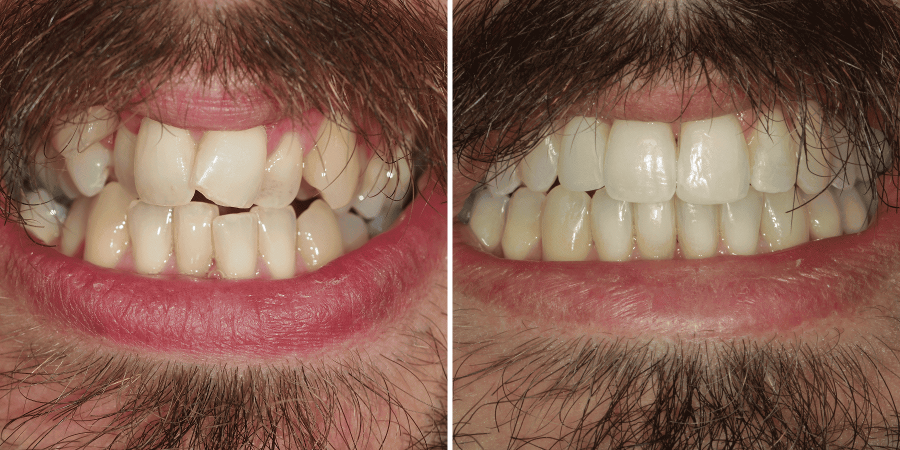 Antes y después de ortodoncia invisible y blanqueamiento, caso 6, en Grandas Dental Spa