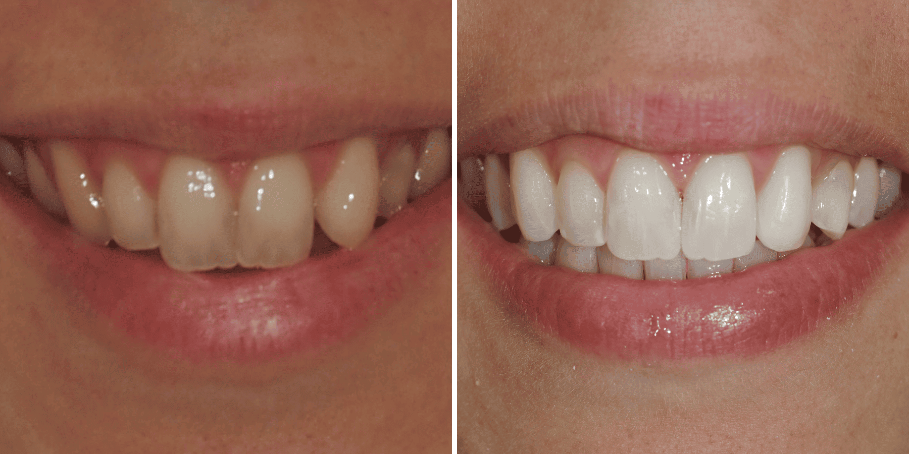 Antes y después de ortodoncia invisible y blanqueamiento, caso 5, en Grandas Dental Spa