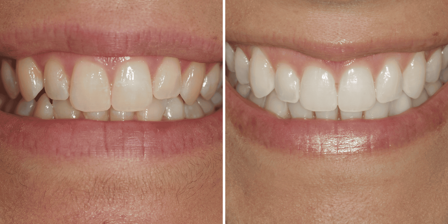Antes y después de ortodoncia invisible y blanqueamiento, caso 2, en Grandas Dental Spa