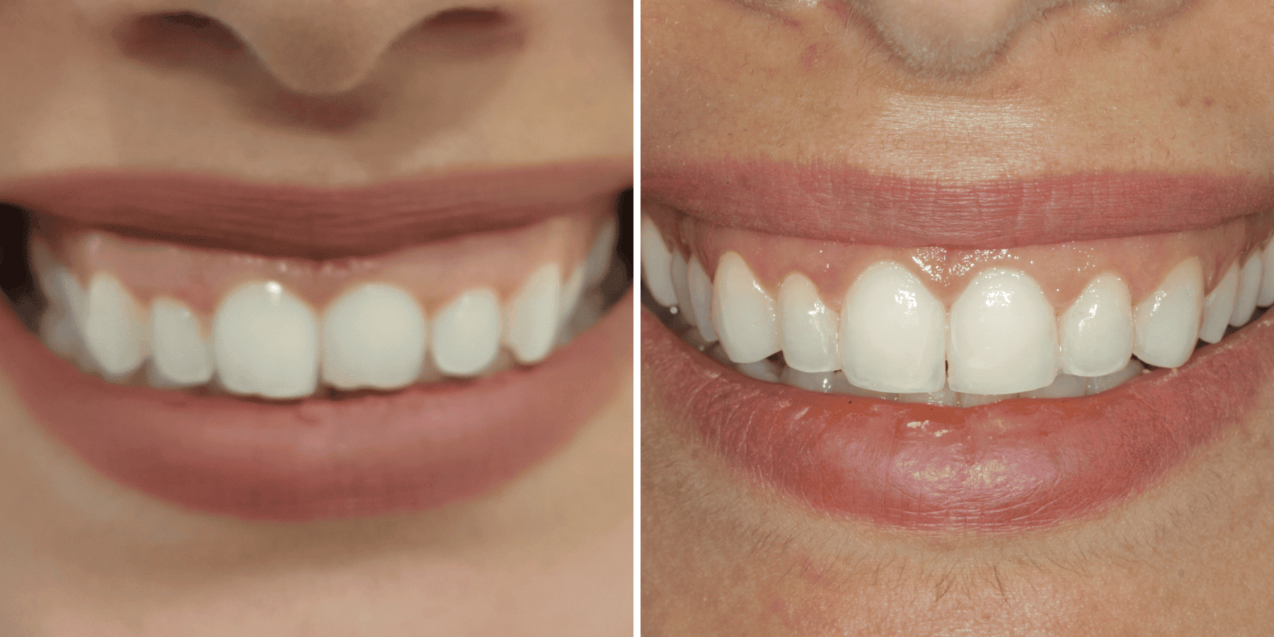 Antes y después de remodelado de encías, caso 2, en Grandas Dental Spa