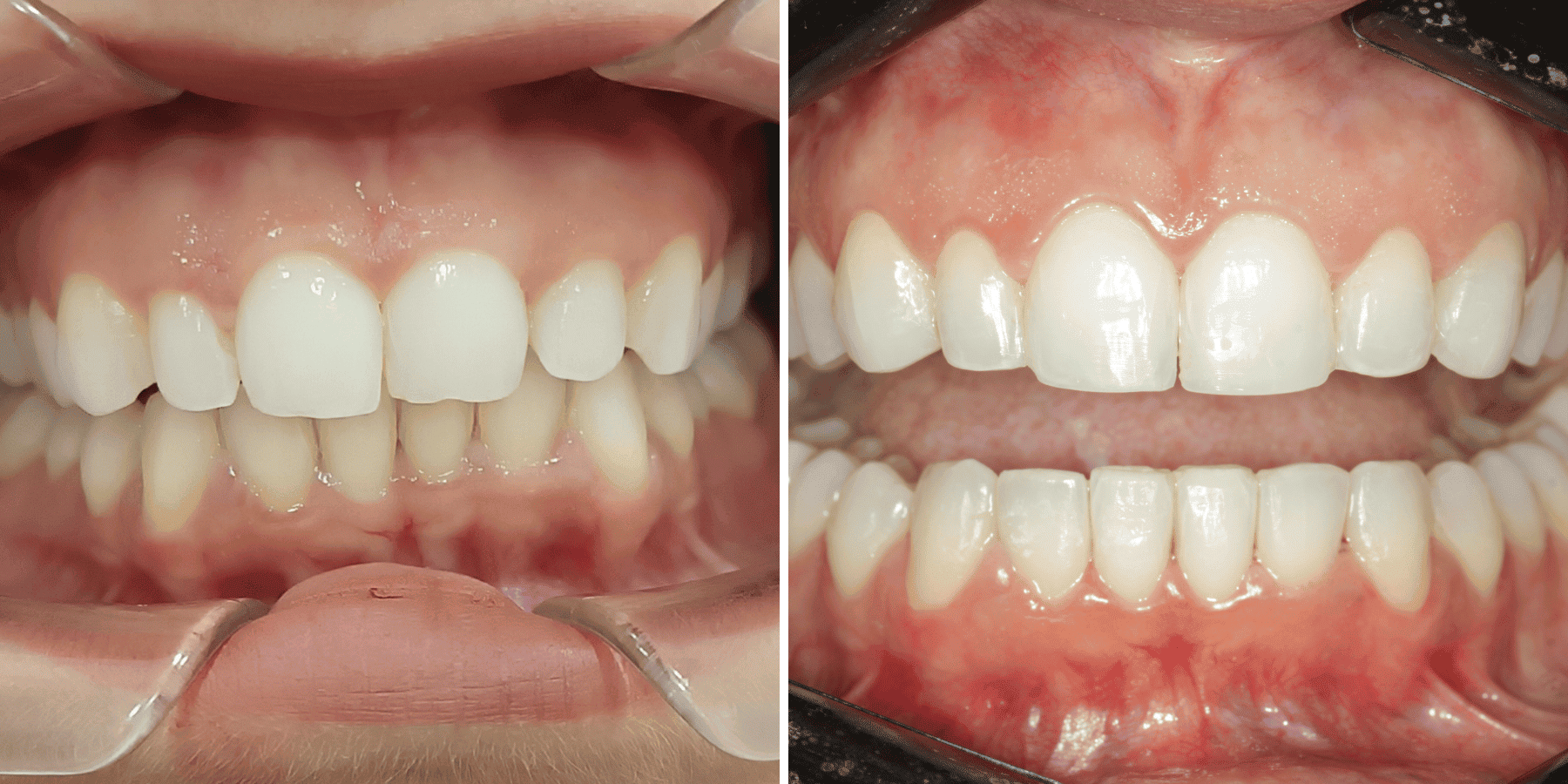 Antes y después de remodelado de encías, caso 1, en Grandas Dental Spa