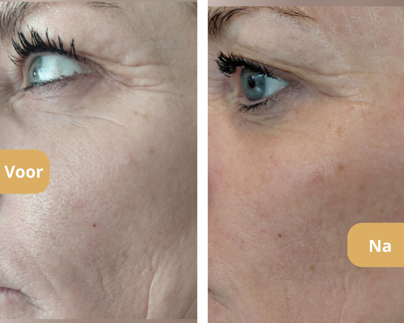 Voor en na resultaat skinbooster Pure Skin Atelier