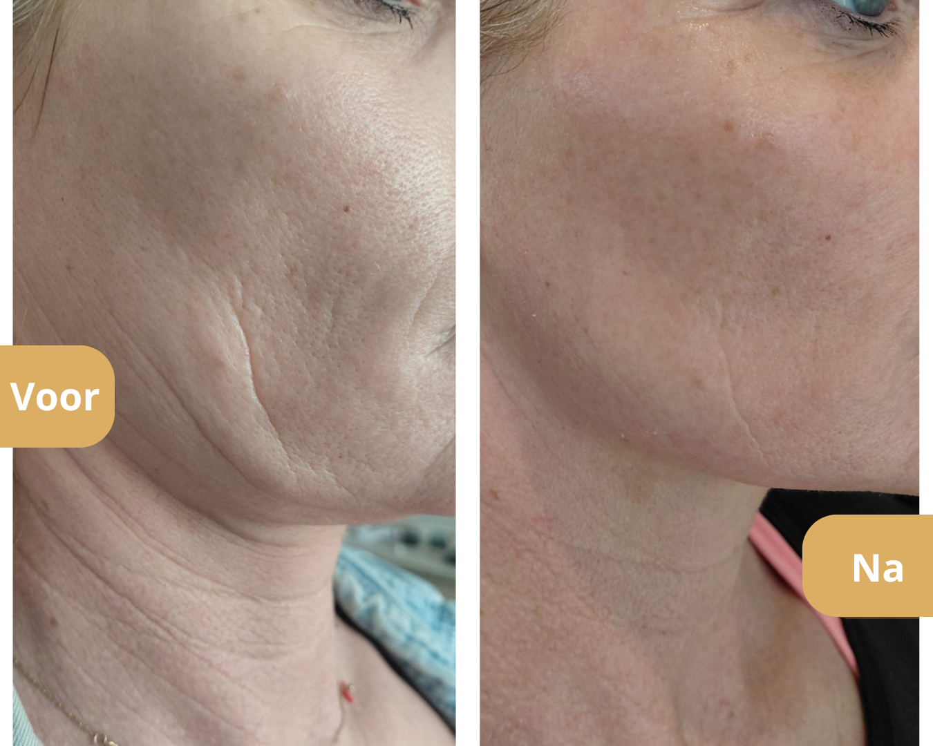 Resultaat PDRN skinbooster behandeling Pure Skin Atelier Den Haag