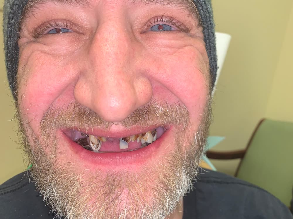 David before treatment