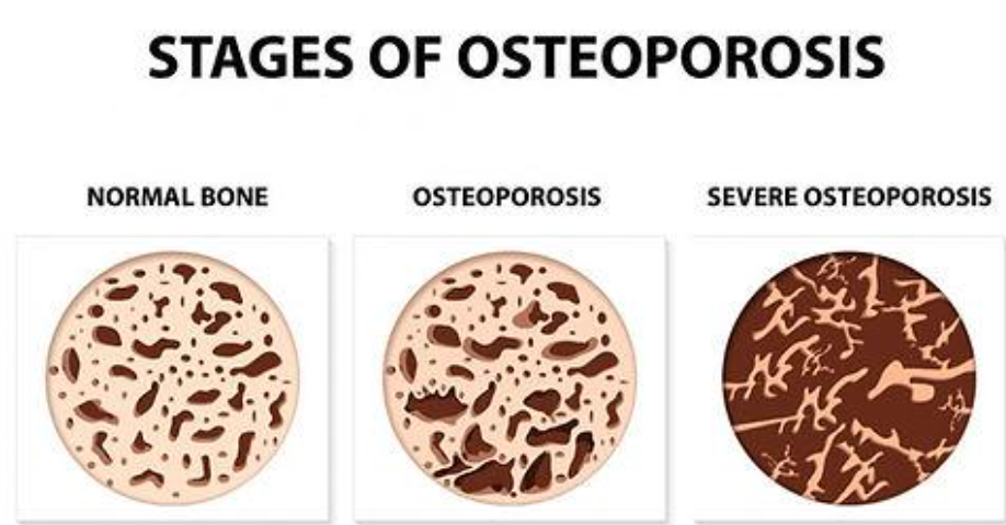 Osteoporosis 1