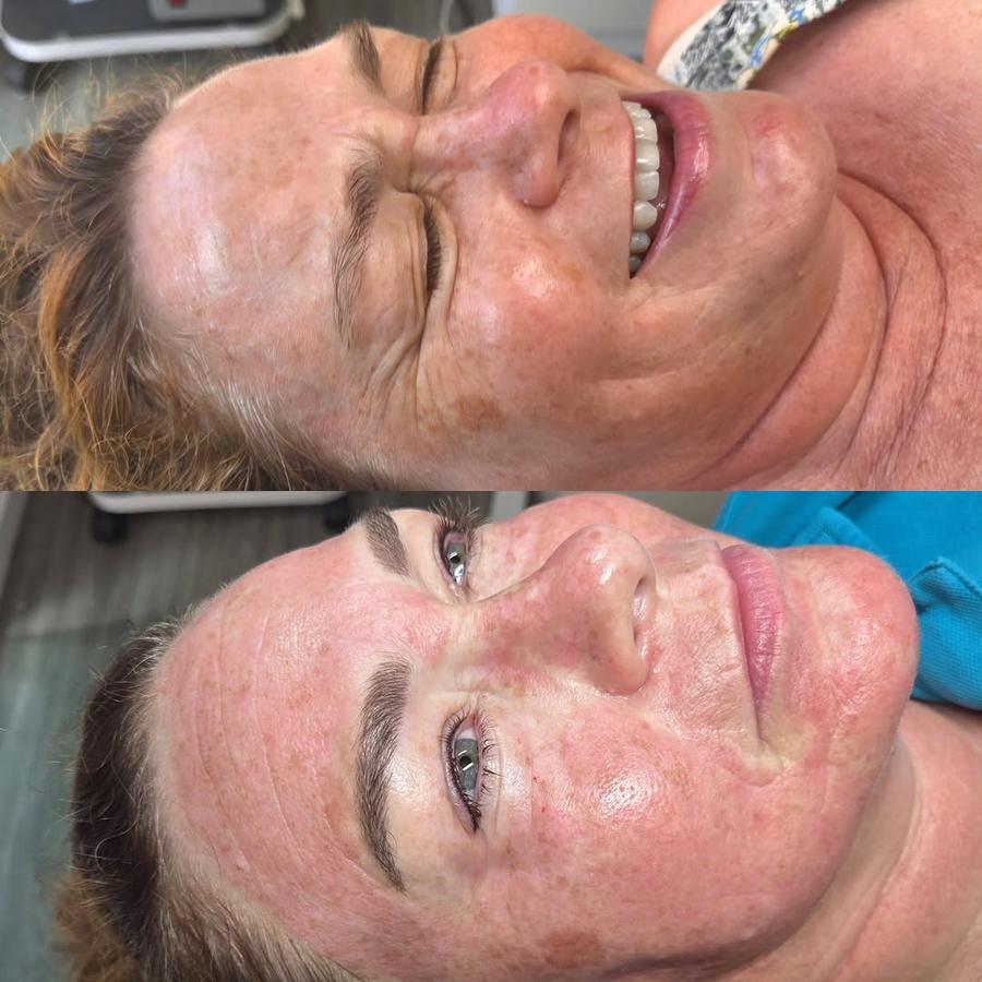 Cosmetic Tattoo healed result
