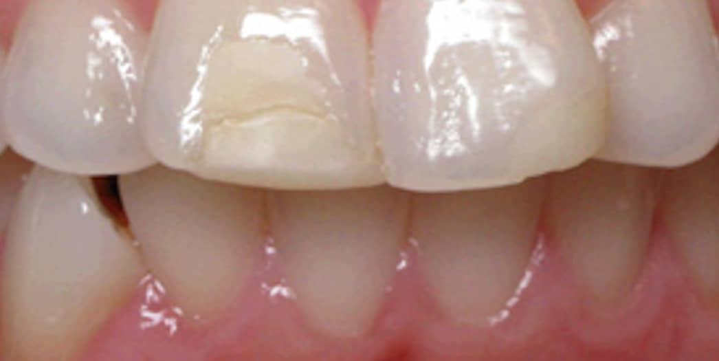 Before Invisalign – adult male case 2