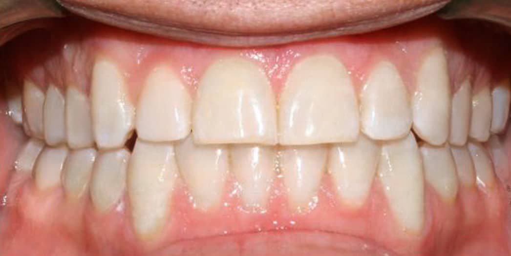 After Invisalign – adult male