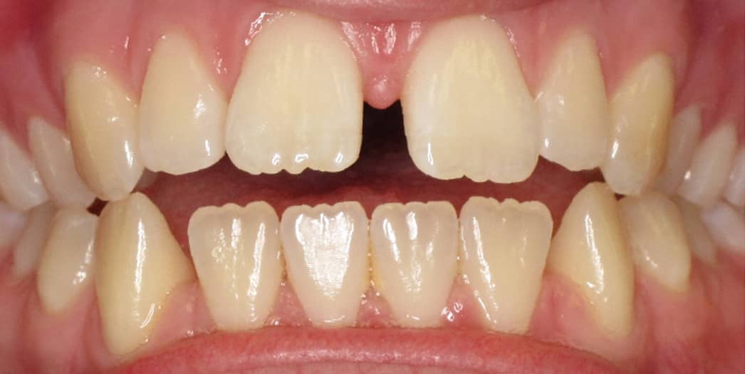 Before Invisalign – teen girl