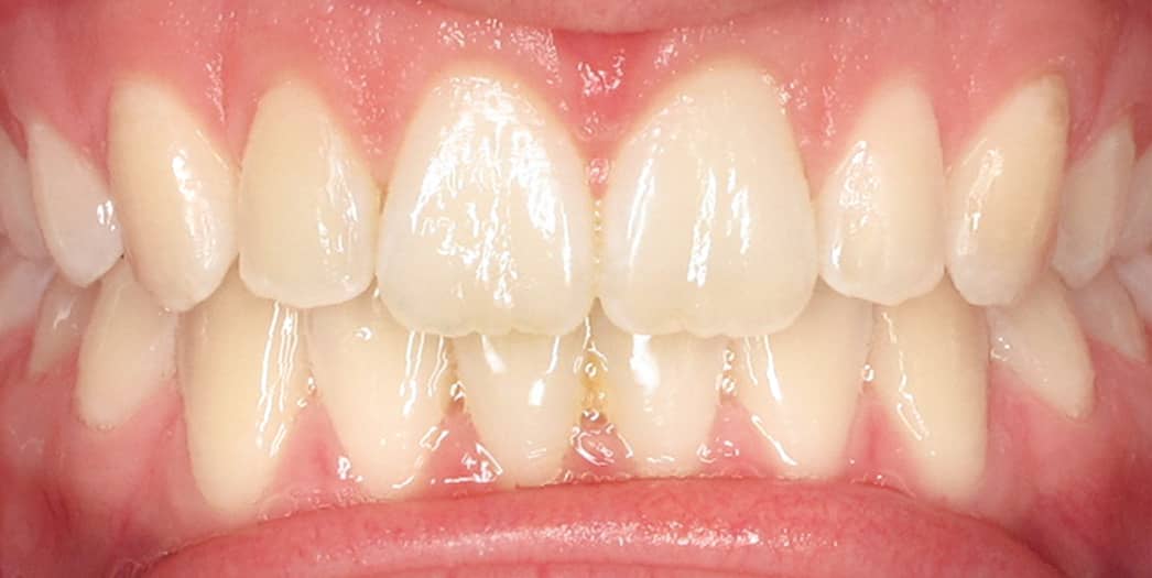 After Invisalign – teen girl