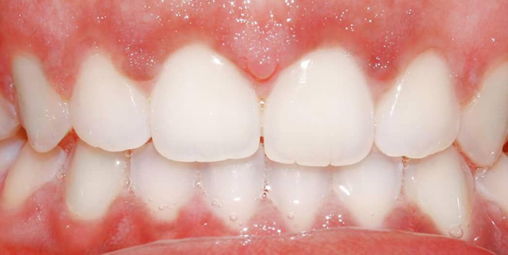 After Invisalign – adult woman