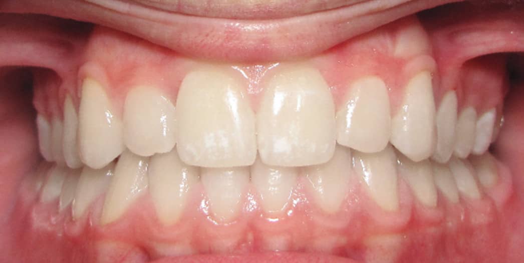 After Invisalign – teen boy