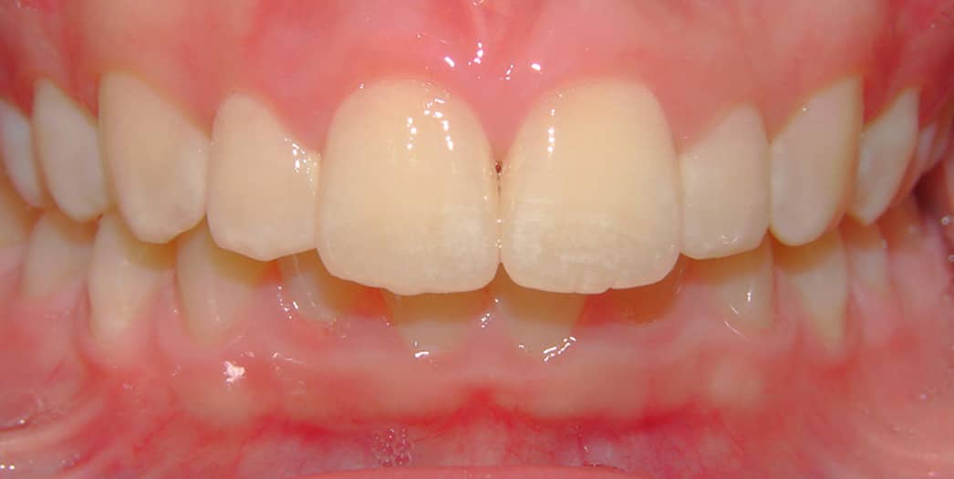 Before Invisalign treatment – kid