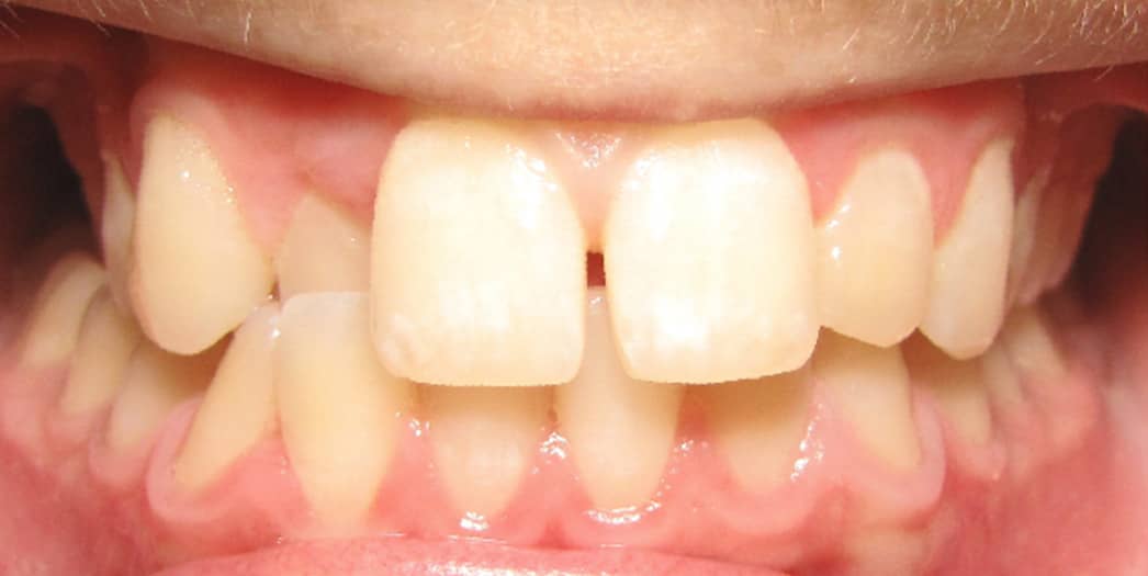 Before Invisalign – teen boy