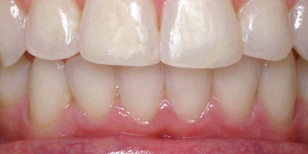 After Invisalign – adult male case 2