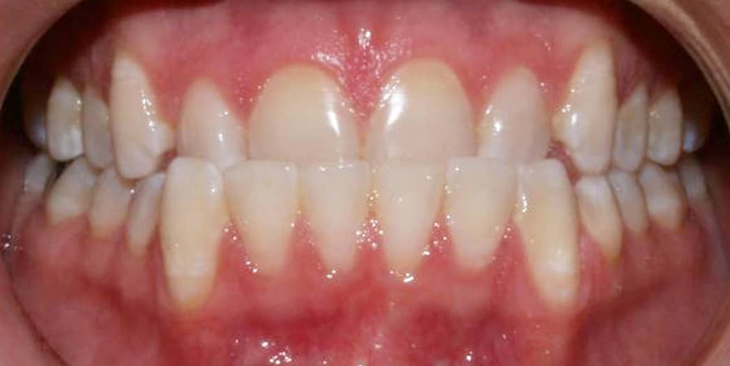 Before Invisalign – adult male