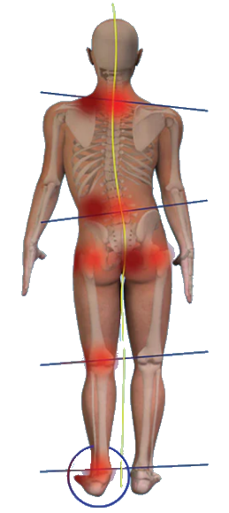 Limb Length Discrepancy 