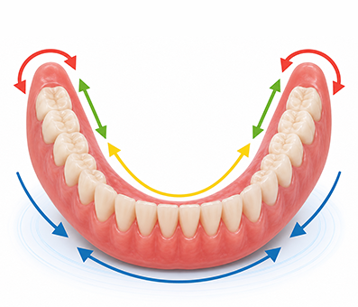 Lower suction dentures (SEMCD)