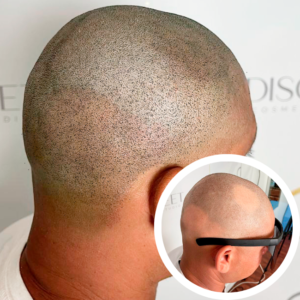 Vitamin D3 treatment image