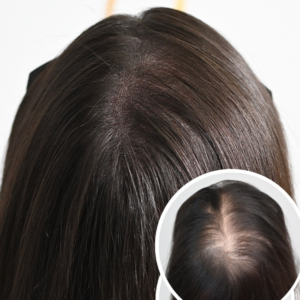 Vitamin D3 treatment image