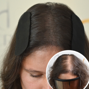 Vitamin D3 treatment image