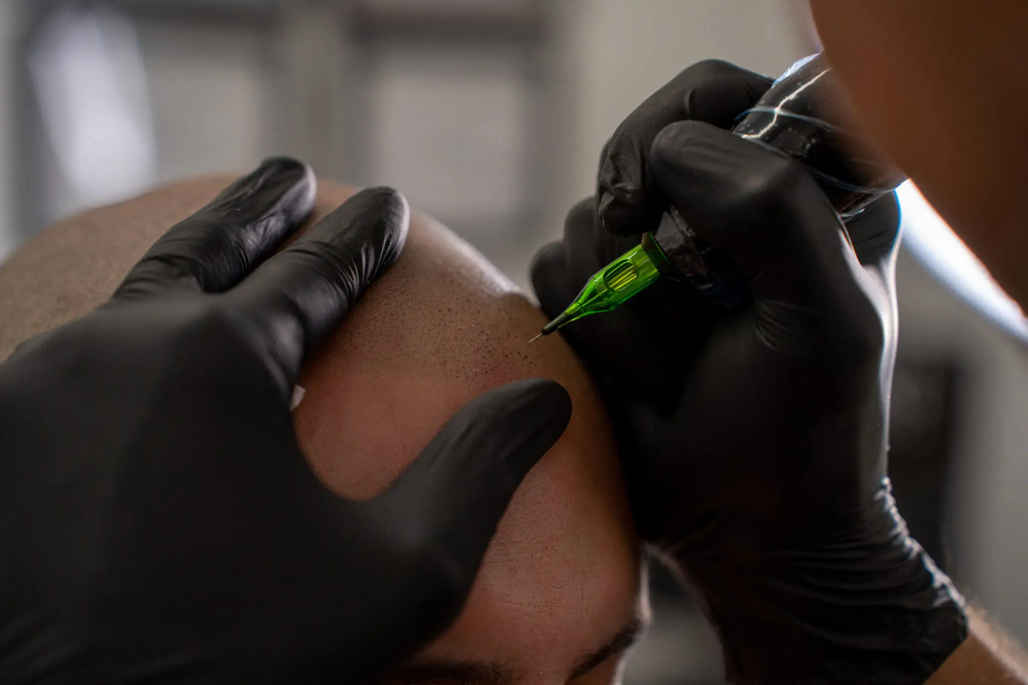 Scalp Micropigmentation