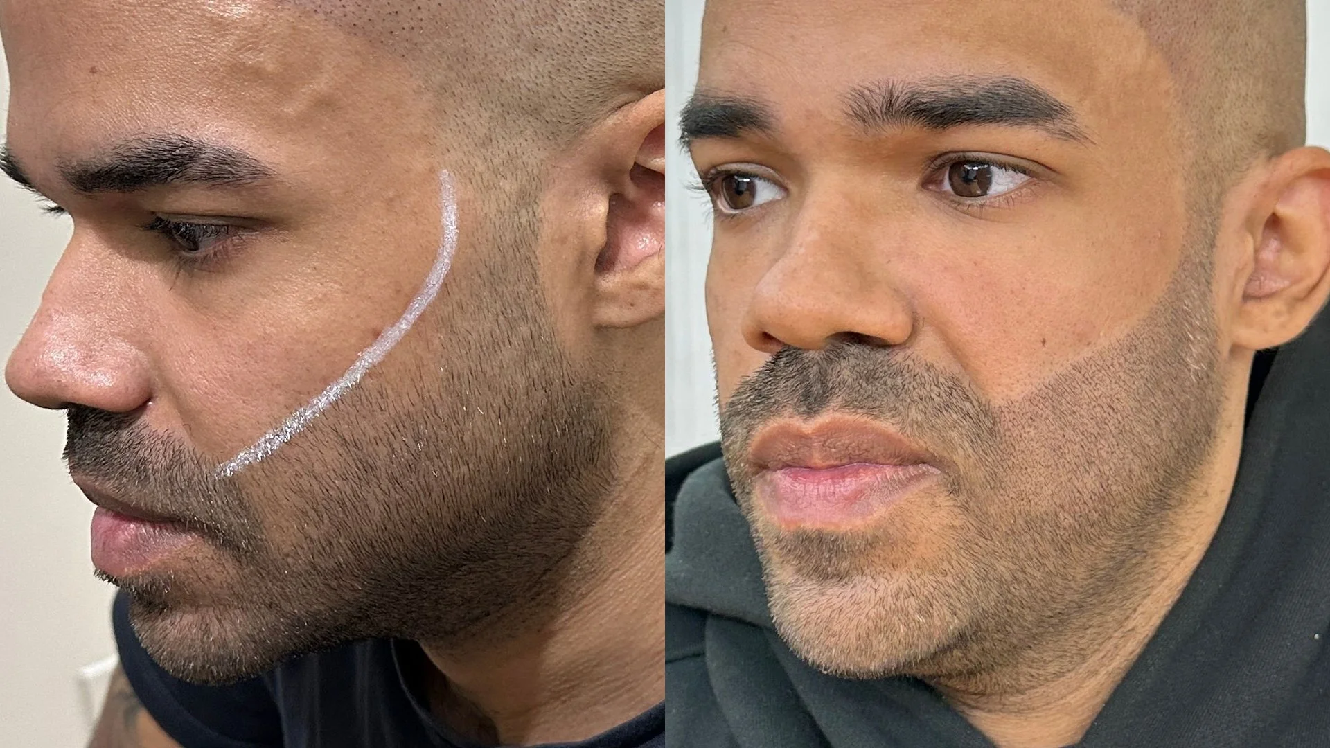 Vitamin D3 treatment image