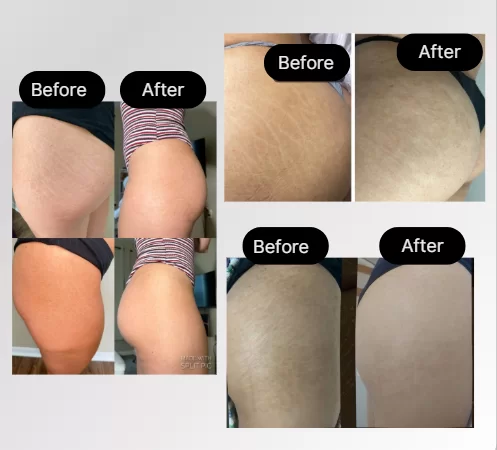 Stretch Mark Camouflage