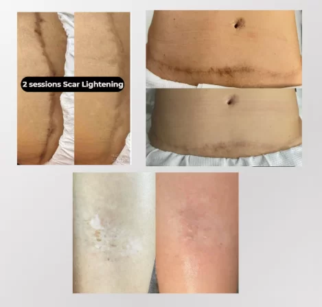 Scar Camouflage and Lightening