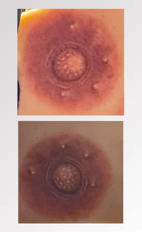 3D Areola and Belly Button Reconstruction