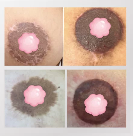 Areola Contour Harmonization