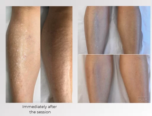 Camouflage for White Spots and Vitiligo