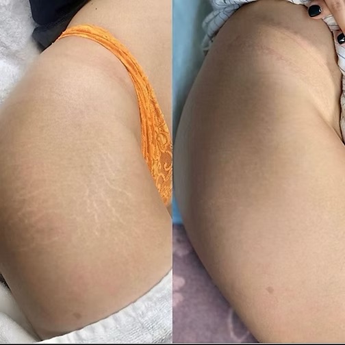 Vitamin D3 treatment image