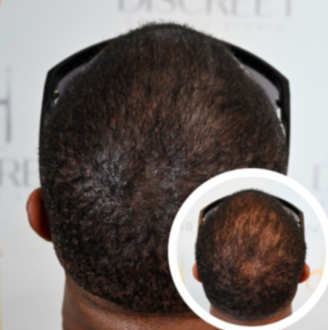 Vitamin D3 treatment image