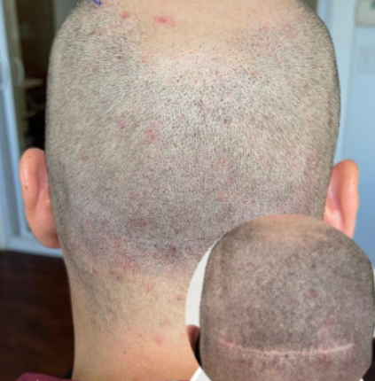 Vitamin D3 treatment image