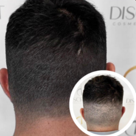 Vitamin D3 treatment image